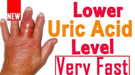 Home Remedies To Reduce Uric Acid How To Lower Uric Acid Naturally