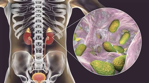 Zapalenie nerek jak rozpoznać jak leczyć To musisz wiedzieć