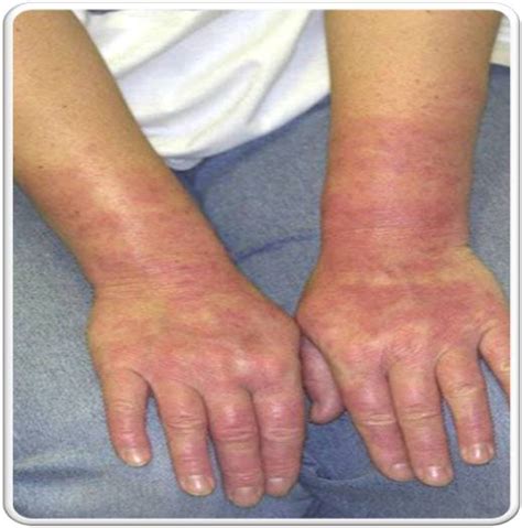 Urticaria Classification And Causes