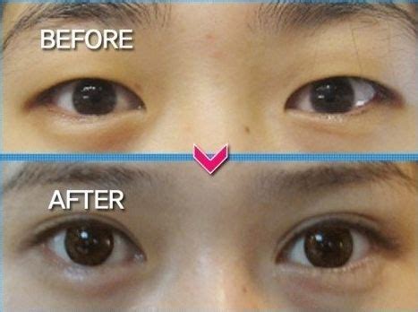 Crazy Before And After Photos Of Korean Plastic Surgery Korean Plastic Surgery Plastic