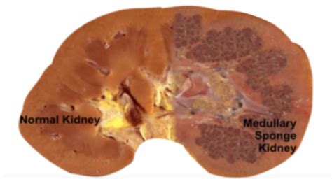Medullary Sponge Kidney New