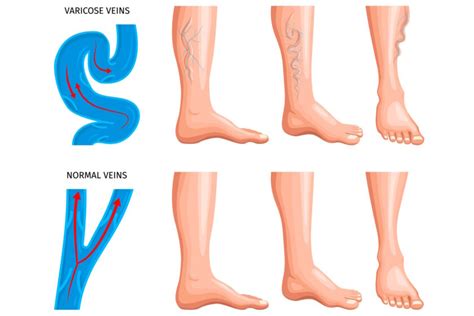 Varicose Veins 7 Signs You Need To See A Vein Specialist