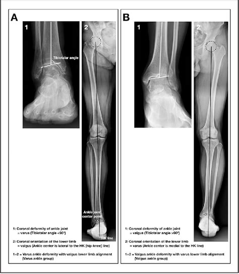 Figure 2 From Dome Supramalleolar Osteotomies For The Treatment Of
