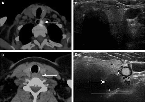 Spectct Guided Ultrasound For Parathyroid Adenoma Localization A 1