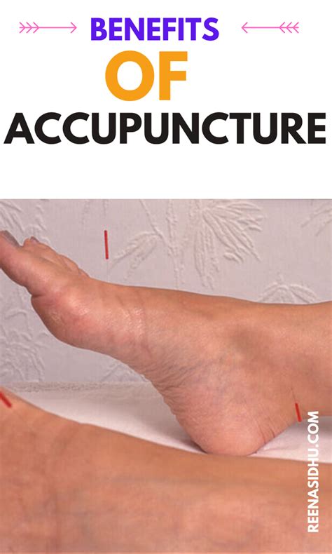 The Many Benefits Of Acupuncture In 2020 Acupuncture Accupuncture