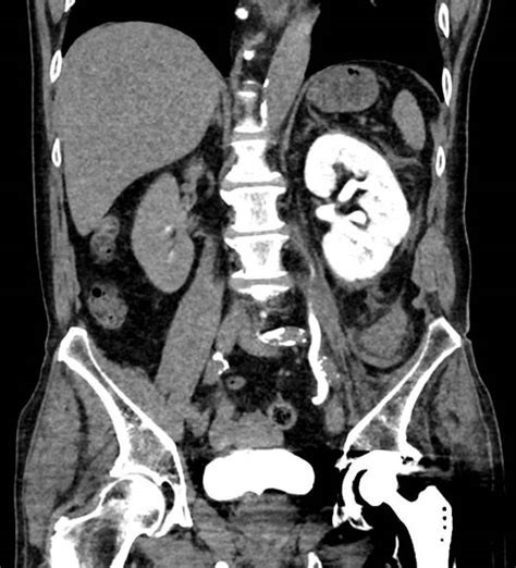 The Unilateral Persistent Nephrogram On Ct Ivp Take Your Time Case