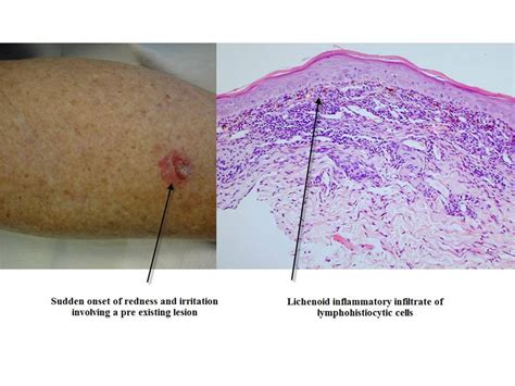 Dermpath Made Simple Neoplastic Solar Keratoses And