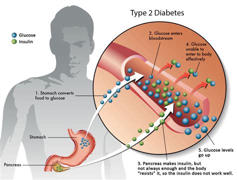 About Diabetes The Madison Clinic