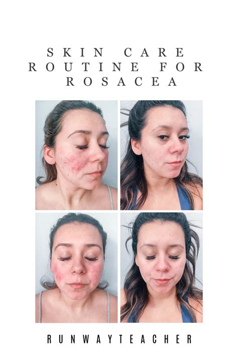 Skin Care Routine For Rosacea