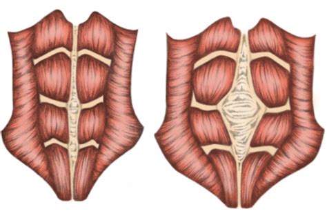 Diastasis Recti Anatomy