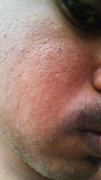 I Have Acne Scars Or Holes On My Face What Is The Best Treatment For
