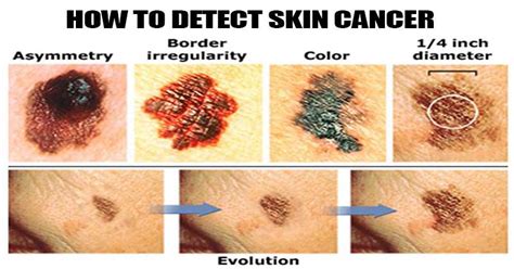 But persistent pain, can also hint at an underlying disease. 10 Telltale Signs of Skin Cancer