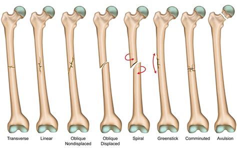 Distal Femur Fracture