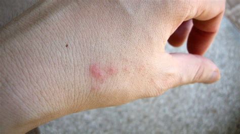 Itchy Bumps On Skin Like Mosquito Bites What Are They Bed Bug Bites Skin Bumps Bug Bites