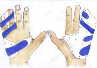Dupuytren's contracture is a fairly common disorder of the fingers. Splintage
