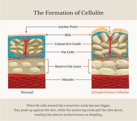 Expat Choice All You Need To Know About Cellulite Treatments At Iyac