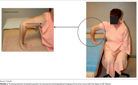 Figure 1 From Ultrasound Diagnosis Of Ulnar Nerve Entrapment By