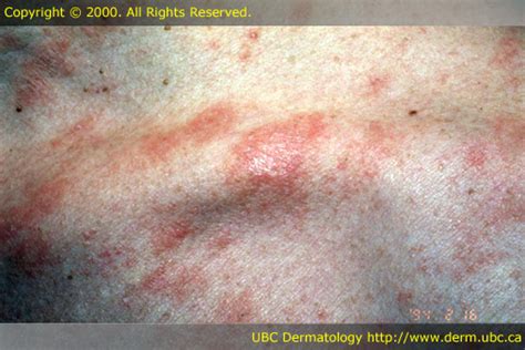 The Rash Of Pityriasis Rosea A Human Herpes Virus 7 H
