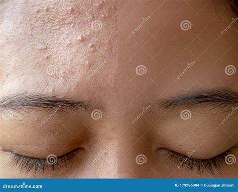 Before and after Acne Treatment Stock Photo - Image of care, body