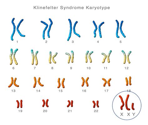 Klinefelters Syndrome Karyotype Acheter Une Photo The Best Porn Website