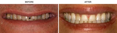 Teeth Grinding Causes Effects And Treatment Holistic Dental Brunswick
