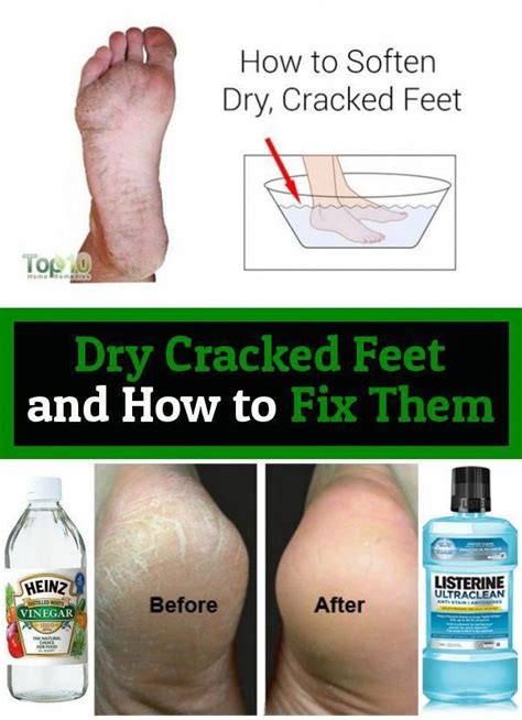 Dry Cracked Feet And How To Fix Them In 2020 Dry Cracked Feet