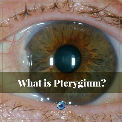 Pterygium Precision Eye Cataract And Laser Eye Surgery