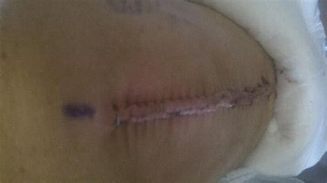 Check spelling or type a new query. Pin on Knee Replacement Scars