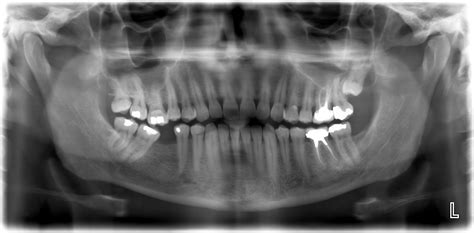 Try to visit your pediatric dentistry & orthodontics if. X-ray review (teeth, dentist, cavity, filling) - Dental ...