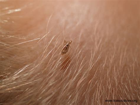 Lice eggs, pictures and unique challenges. Head Lice - Female Louse On Hair Zoomed In On | A female ...