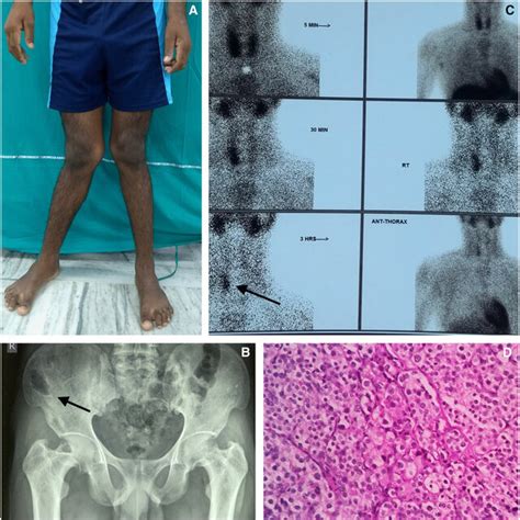 A Bilateral Genu Valgum B X Ray Of Pelvis Showing Lytic Lesion On