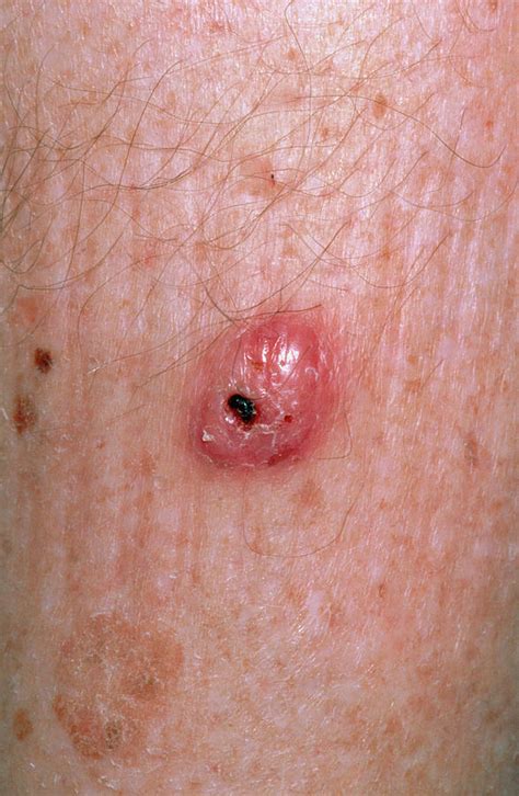 Squamous Cell Carcinoma On Leg Photograph By Dr P Marazziscience