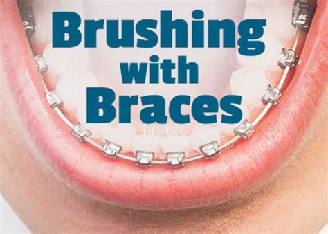 Brushing With Braces In Atlanta Ga Chamblee Orthodontics