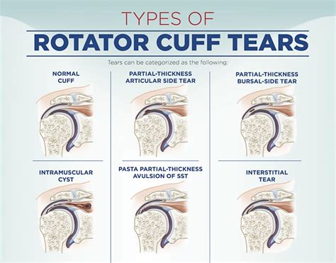 Rotator Cuff Tear Wall Poster Chiropractic And Therapist