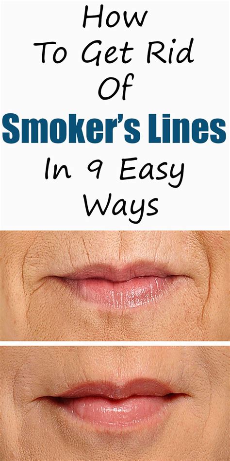 How To Get Rid Of Smokers Lines In 9 Easy Ways Smokers Lines Lip