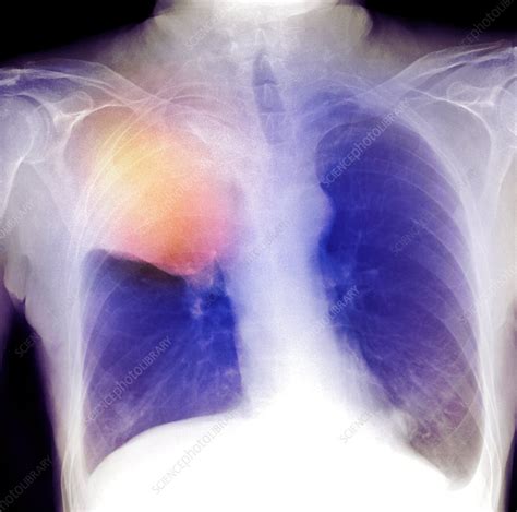 Lung Cancer X Ray Stock Image C0073783 Science Photo Library