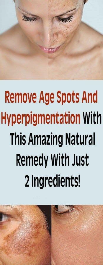 Pin By Jill Sutherland On Health And Fitness Age Spot Removal