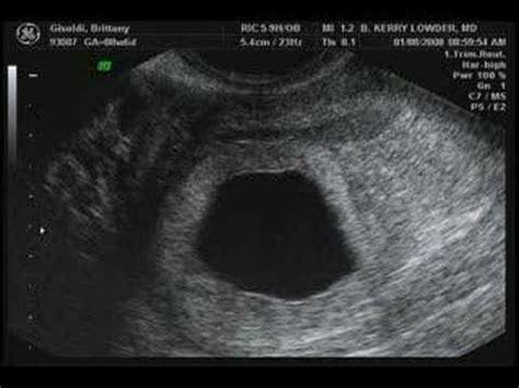 Following a dating scans what to have my toe into the first ultrasound scan from the online dating scan. Ultrasound- 7 weeks, 1 day - YouTube