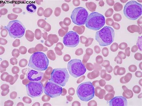 Leukemia is a form of blood cancer that impedes the normal production of white blood cells in the bone marrow. Leukemia. Causes, symptoms, treatment Leukemia