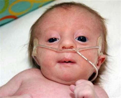Edwards Syndrome Pictures