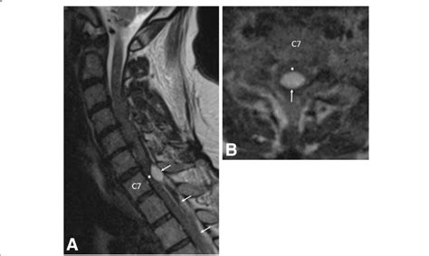 A Pre Operative Sagittal T2 Weighted Mri Of The Cervical Spine