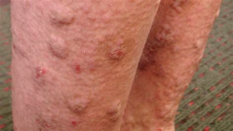 Hiv Blisters Arms