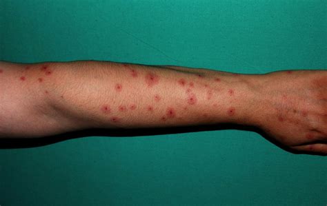 Antiepileptic Drugs (AEDs) linked to rare serious skin reactions ...
