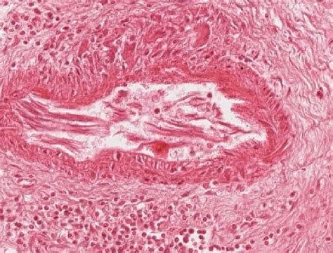 Informationen und hilfe rund um das thema herzmuskelentzündung. el-IPH: Rheumatische Myokarditis · Kurs Allgemeinpathologie