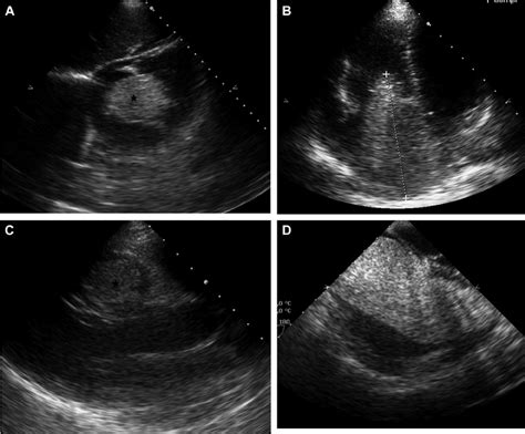 Echocardiography Imaging A Transverse Subcostal View Showing An