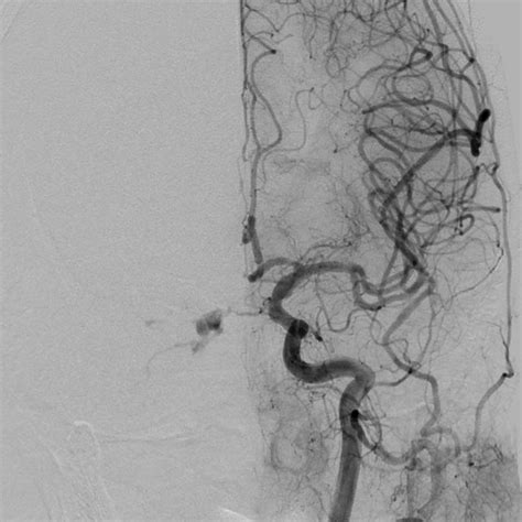 Right Internal Carotid Artery Ica Angiogram Lateral View Showing