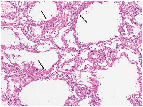 Pathological Findings Of Lungs Were Hyaline Membrane Arrow