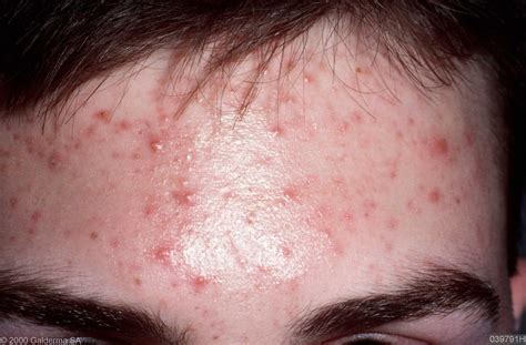 What Is Fungal Acne On Face Caused By