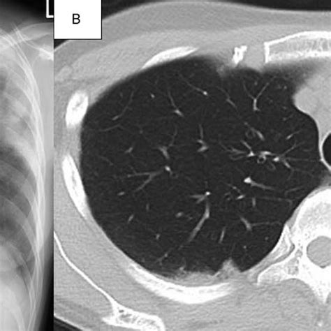 Radiography And Chest High Resolution Computed Tomography Ct Scans