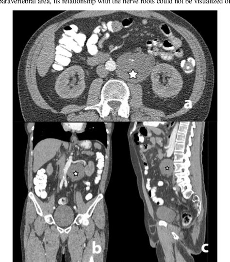 Figure 1 From Giant Retroperitoneal Schwannoma Removed With The